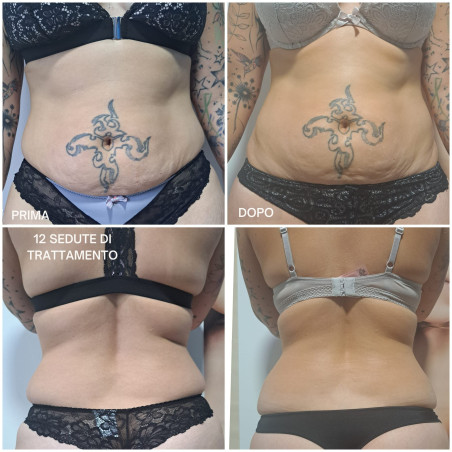 DX TWIN Hyper Pulse® STARVAC: Trattamento Non Invasivo per Rimodellamento e Tonicità di Viso e Corpo