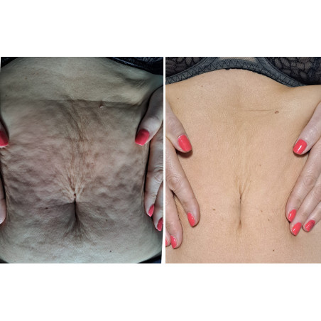 DX TWIN Hyper Pulse® STARVAC: Trattamento Non Invasivo per Rimodellamento e Tonicità di Viso e Corpo