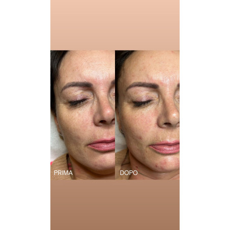 DX TWIN Hyper Pulse® STARVAC: Trattamento Non Invasivo per Rimodellamento e Tonicità di Viso e Corpo