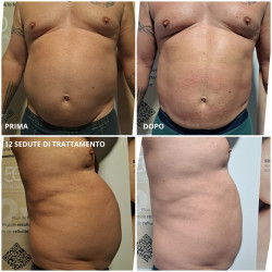 Hyper Pulse® STARVAC: Tecnologia non invasiva per Rimodellamento Corpo e Rassodamento Pelle